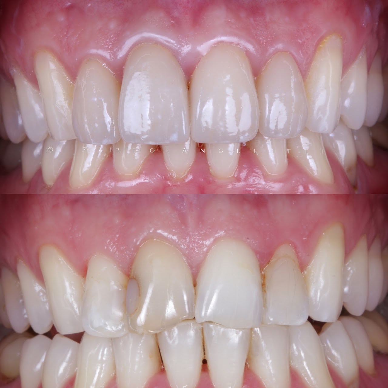 Resultado de tratamiento odontológico realizado en Angeletti Estética Odontológica